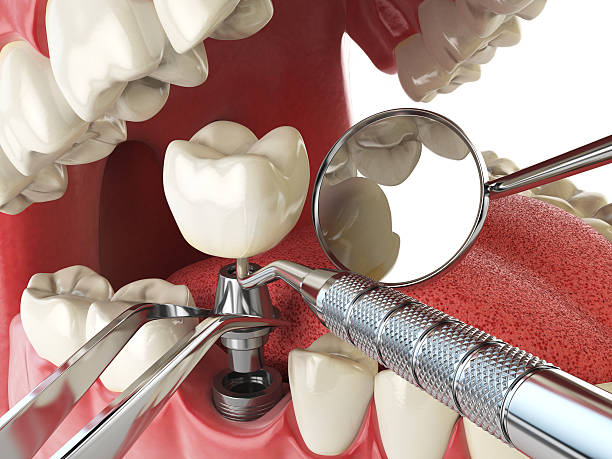 Best Dentist for Tooth Abscess  in Cameron, MO